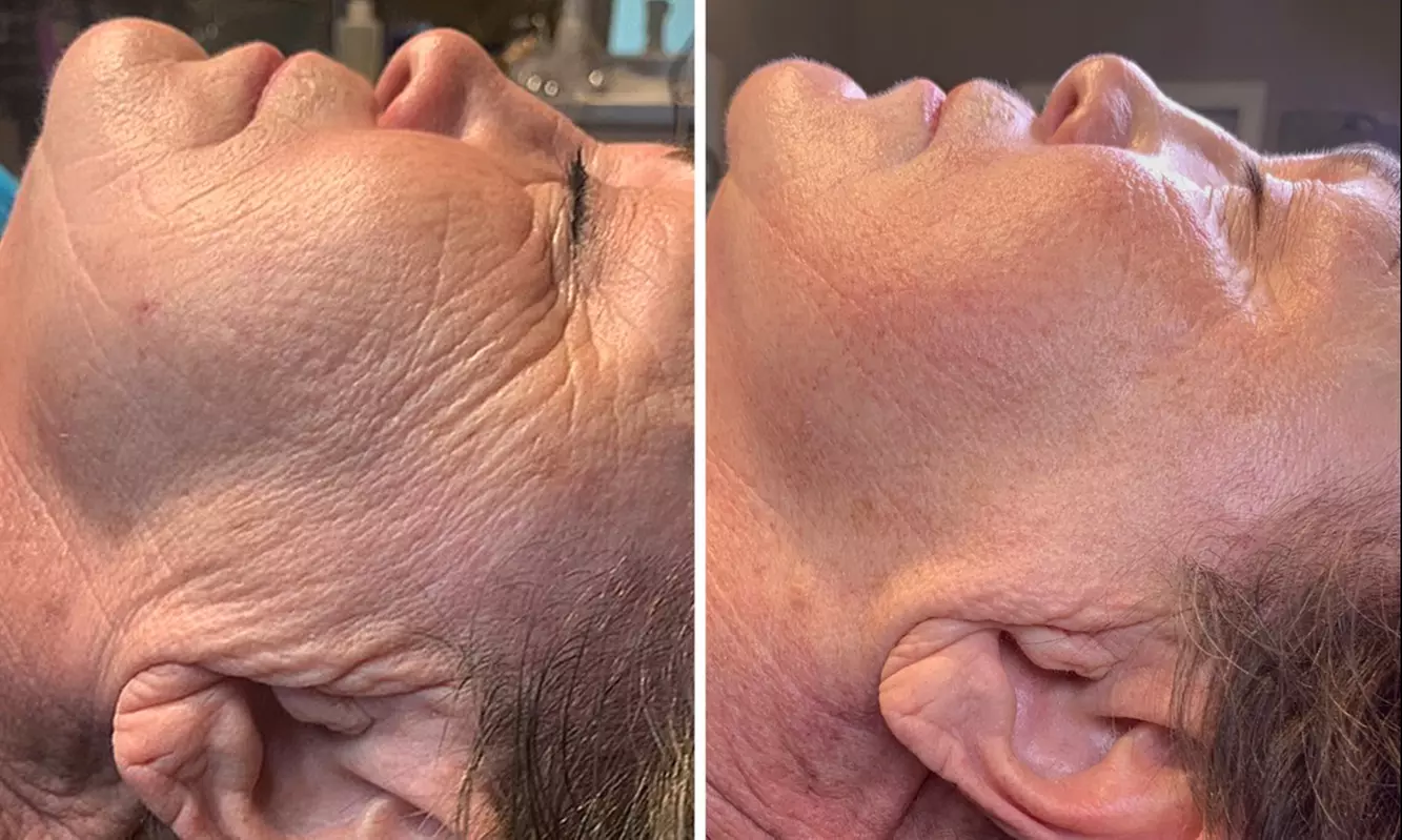 Up to 56% Off on Micro-Needling at Inspire Medical Aesthetics - Second Medium