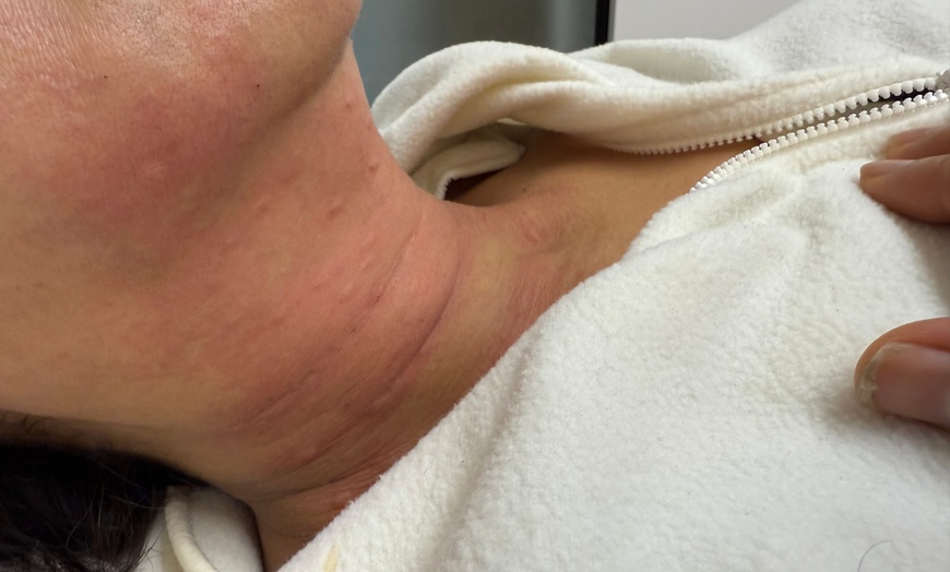 Image 5: Polynucleotide Skin Rejuvenation– Glow&Sip: Refreshing tea Included!☕✨