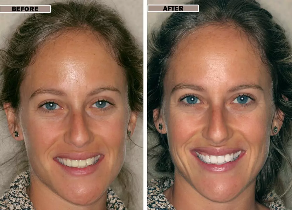 Up to 70% Off on Teeth Whitening - In-Office - Branded (Zoom, Brite Smile) at SmileHealth Teeth Whitening - Second Medium