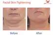 Up to 50% Off on Radio Frequency Skin Tightening at Skin And Laser Clinic - Image 2