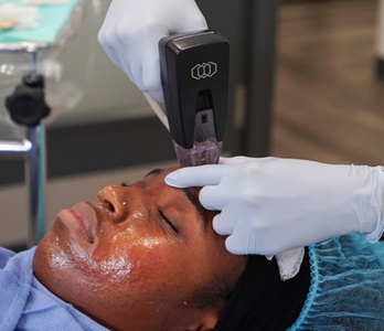 One Morpheus8 Treatment: Full Face - Rejuvenescence Med Spa