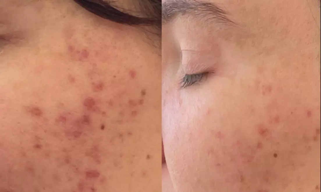 Up to 20% Off on Chemical Peel at Mimosa Spa