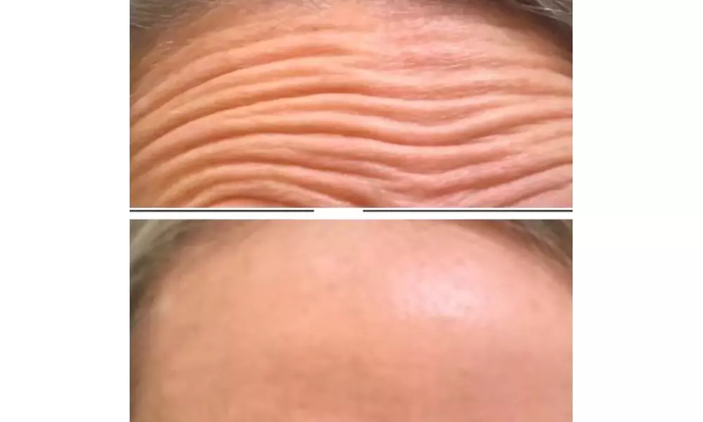 Experience Dysport Injections at Laser Sculpture Inc. with Up To 100 Units and Save Up To 39% Off - Second Medium