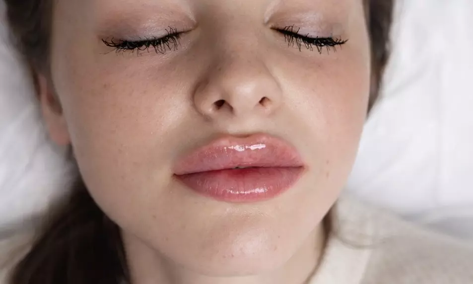 Premium Dermal Filler (REVOLAX®) - 0.5 or 1ml (Up to 57%Off)