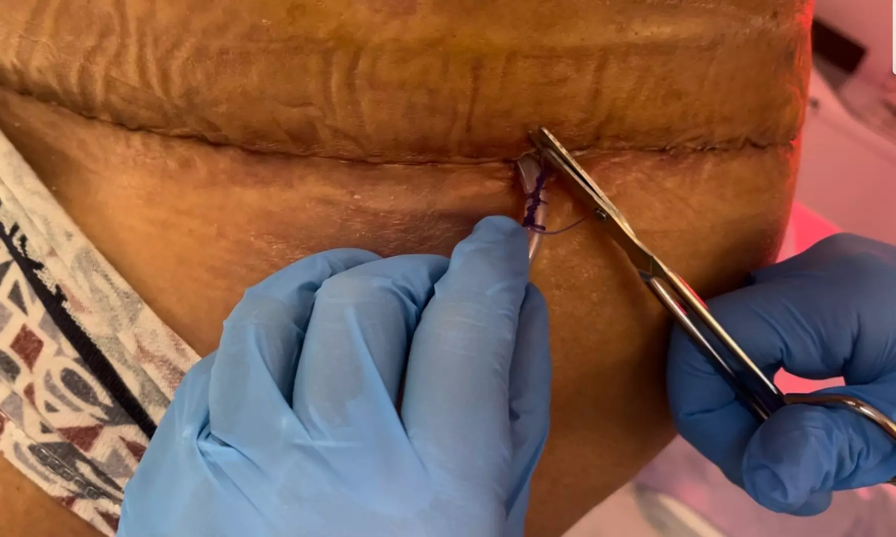 Post Op Drainage Treatments for Healing and Comfort