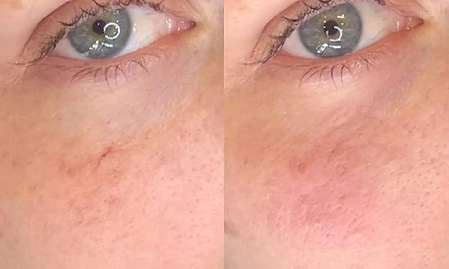 Up to 40% Off on Facial - Blemish Treatment at Enhanced Esthetics - Oakland Esthetician and Microblading - Primary Image