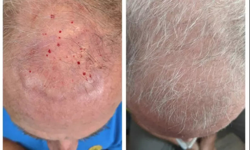 One or Three PRP, or One or Two PRP Exosome Treatments at Premier Shockwave of Austin
 (Up to 30% Off) - Primary Image