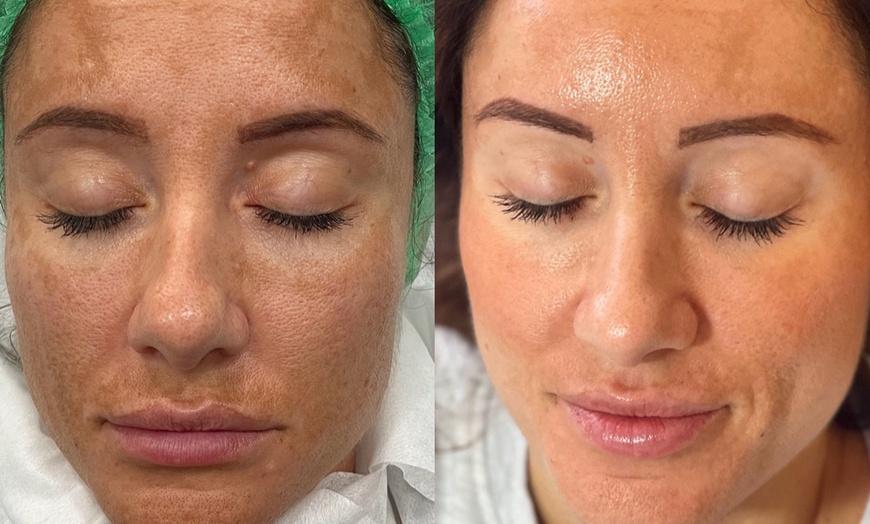 Image 1: Unlock Radiant Skin with Luxury Micro-Needling with Exosomes 