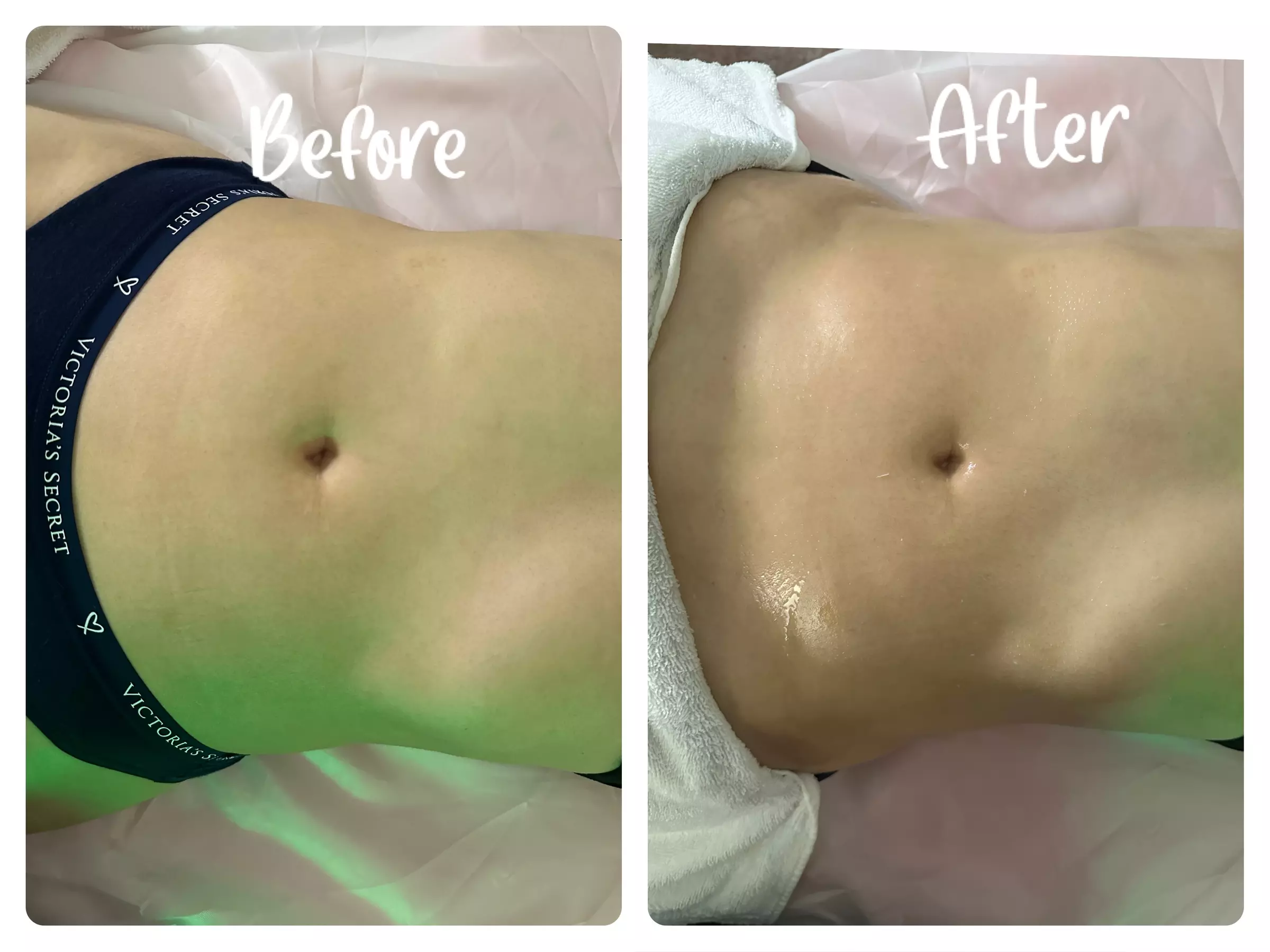 Ultrasonic Body Sculpting Sessions at Dyamond sculpted