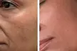 Transform Your Skin with One or Three CO2 Skin-Resurfacing Sessions at Amora Med Spa (Up to 77% Off) - Second Medium