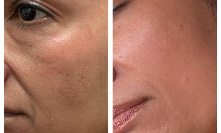 Image 5: Transform Your Skin with One or Three CO2 Skin-Resurfacing Sessions