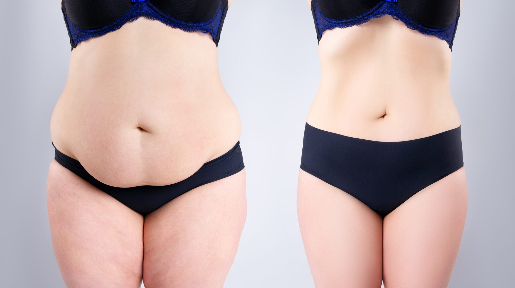 Try Consultation with Lipo Laser Session Today