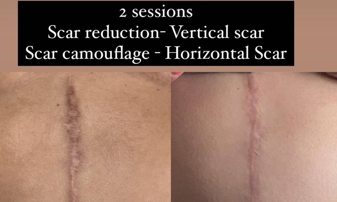 Non-invasive scar blending and lightening services for smooth skin