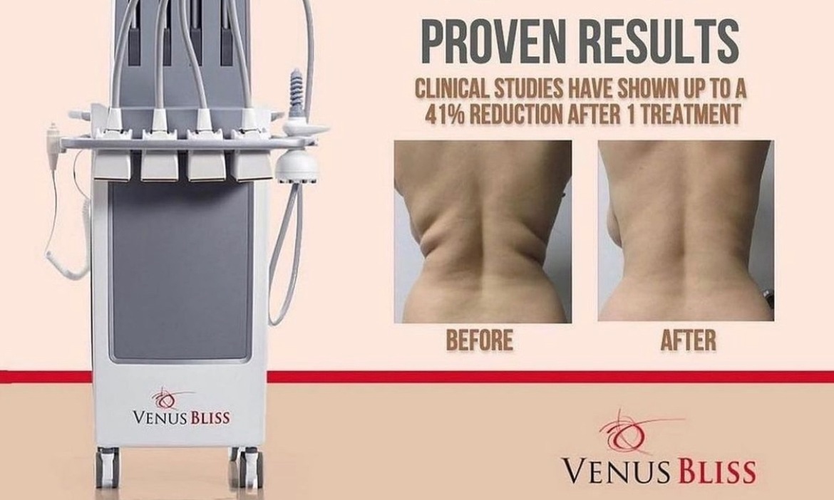 Discover the Power of Venus Bliss:  Laser Lipolysis Treatments at Black Bella Dc Body Sculpting (Up to 40% Off)