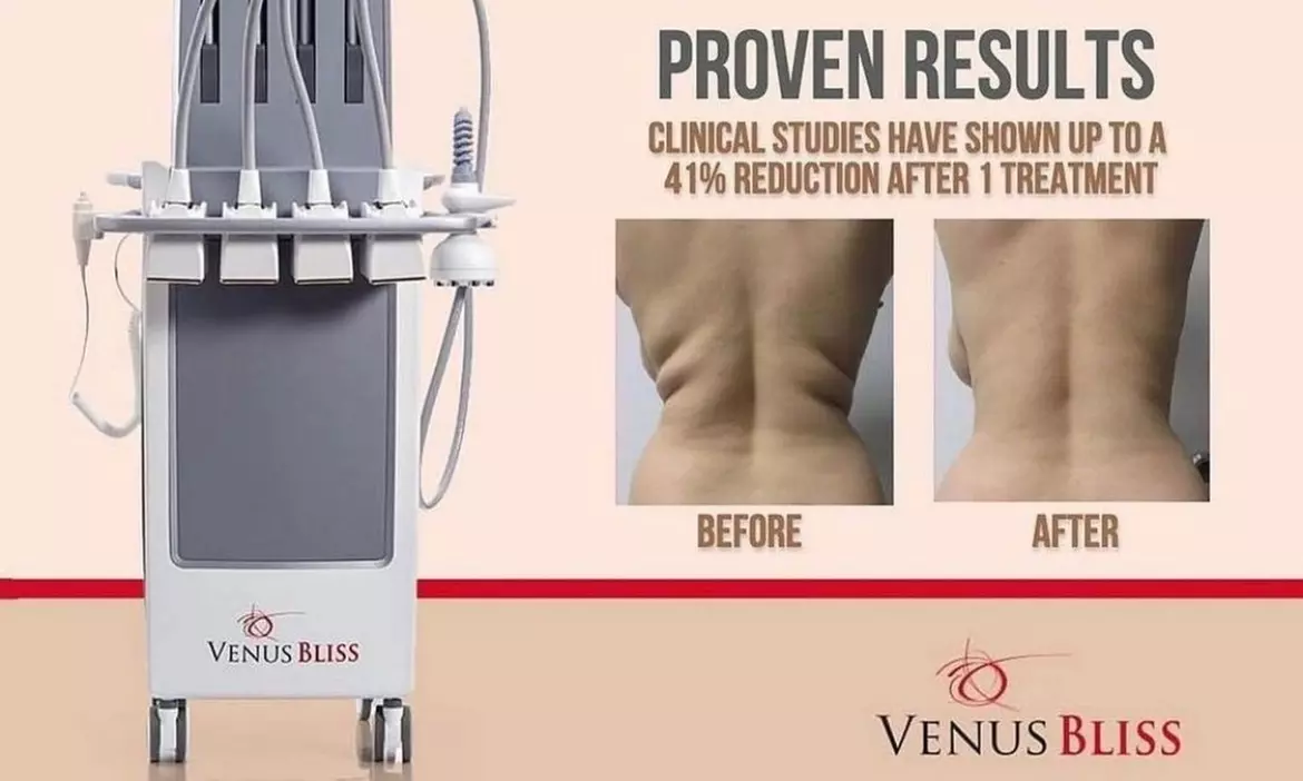 One or Two Laser Lipolysis Treatments at Black Bella Dc Body Sculpting