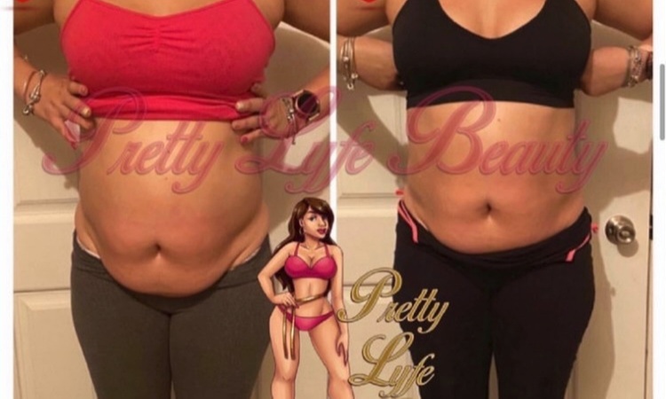 Up to 65% Off on Radio Frequency Skin Tightening at Pretty Lyfe Esthetics