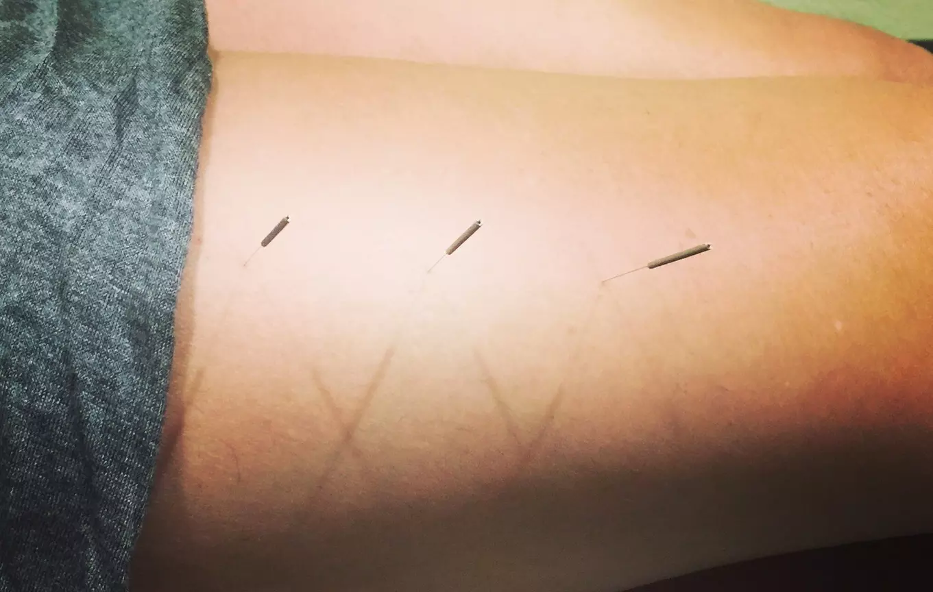Experience acupuncture sessions for natural pain relief