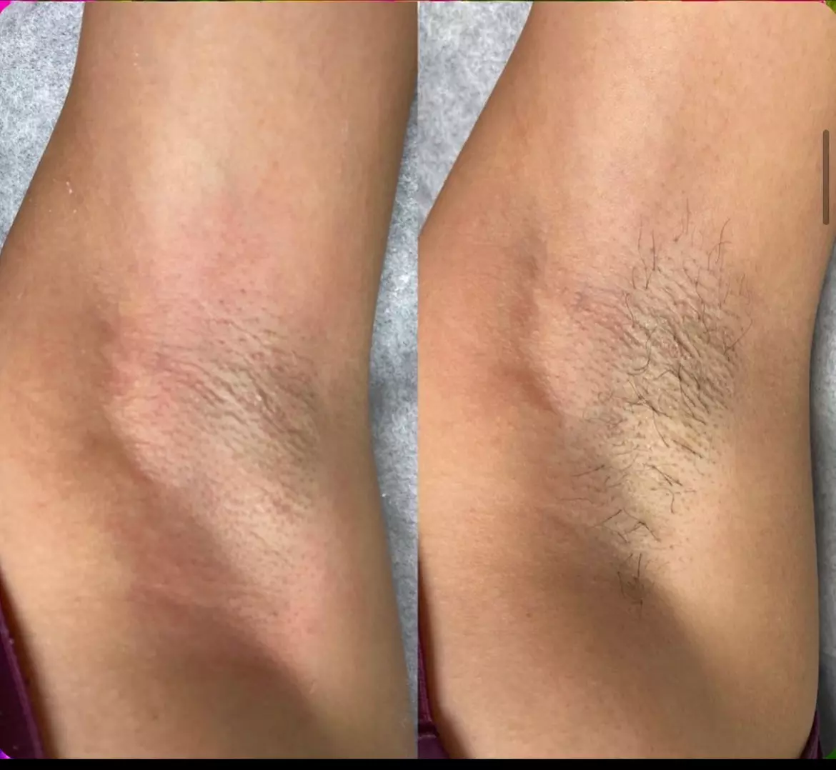 Experience Evolve Skin and Wax's Brazilian and Underarm Services, Up to 42% Off - Primary Image