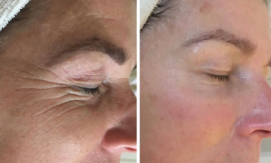 Image 9: 3 o 6 sesiones de lipoláser, radiofrecuencia y presoterapia