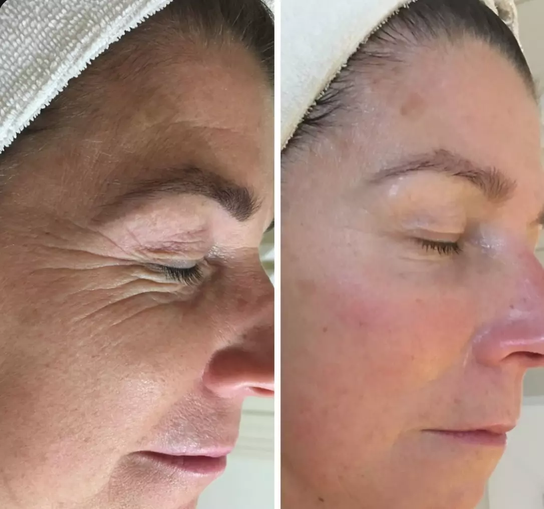 3 o 6 sesiones de lipoláser, radiofrecuencia y presoterapia