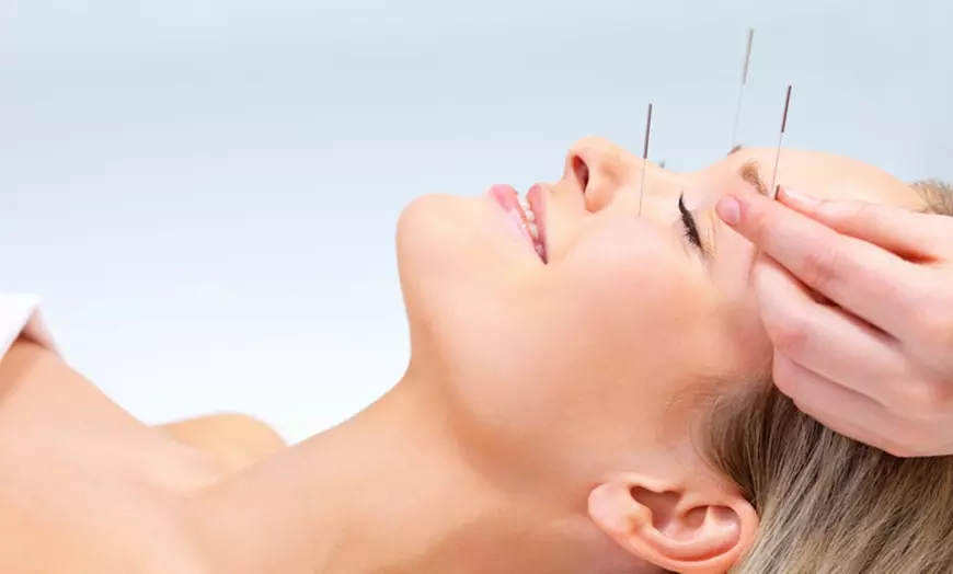Image 1: Hasta 58% de descuento en Medicina china tradicional - TCM en tratamientos por acupuntura