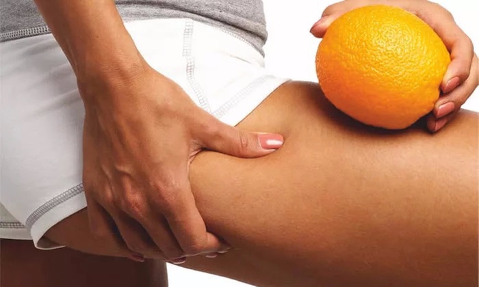 Three VelaViShape body contouring and cellulite reduction sessions