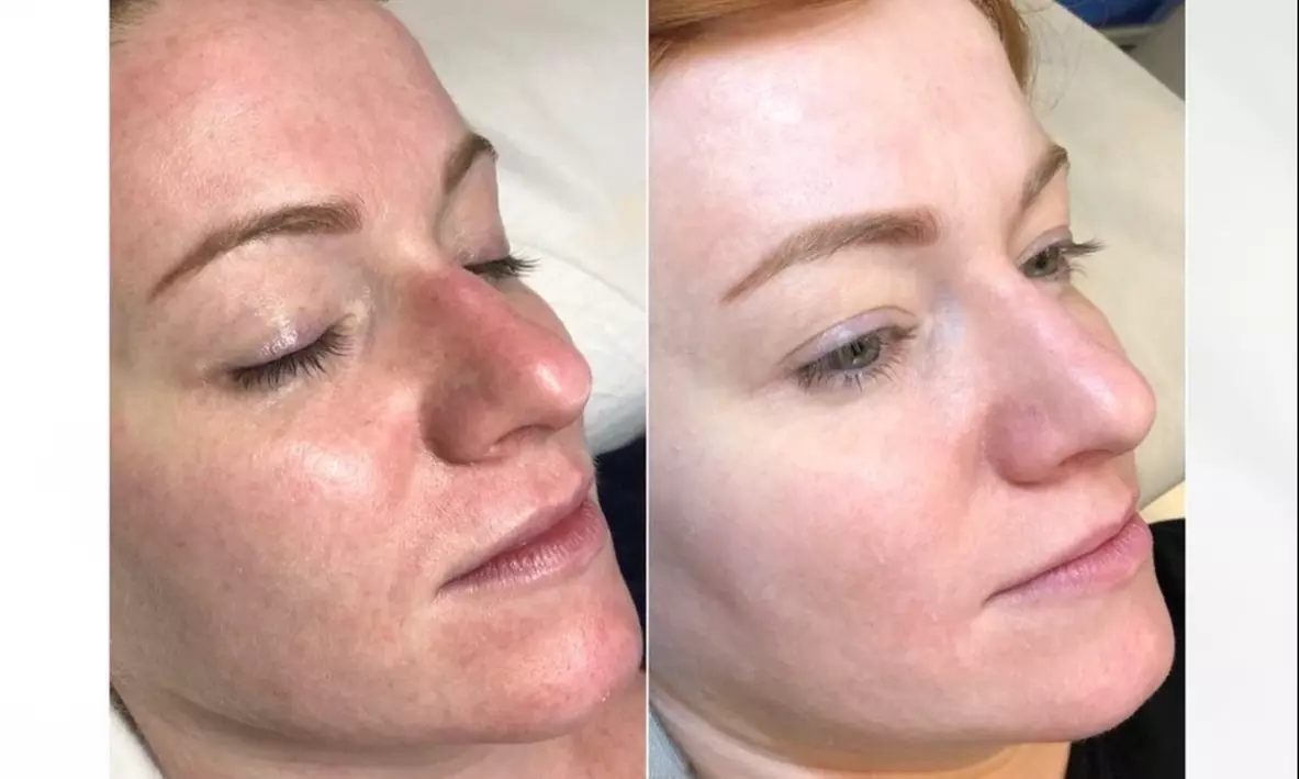 Experience Pure Glow Skin Studio's BB Glow Treatment for Radiant Skin with up to 20% Off - Second Medium