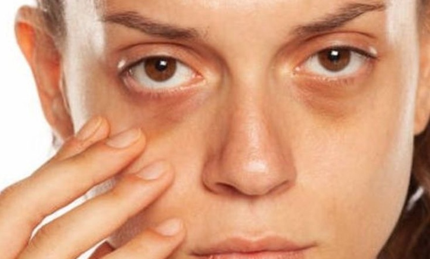 Image 2: Up to 50% Off on Dark Circle / Under Eye Treatment at Aesthetics By Shanty