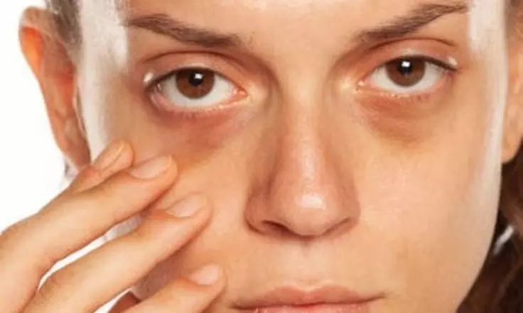 Up to 65% Off on Dark Circle / Under Eye Treatment at Aesthetics By Shanty - Image 2