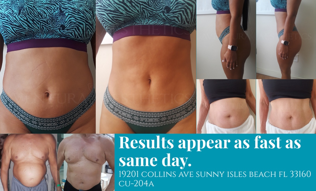 Non-Invasive 3D Laser Lipo Treatment for Targeted Areas