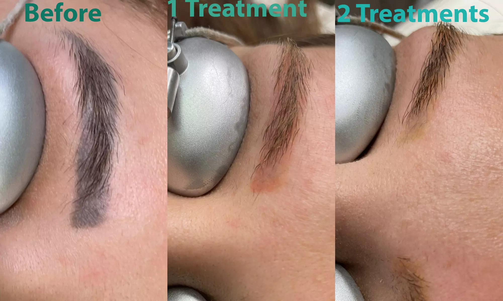 Permanent Makeup Removal at Wise Choice Tattoo Removal (Up to 25% Off). Two Options Available. - Primary Image