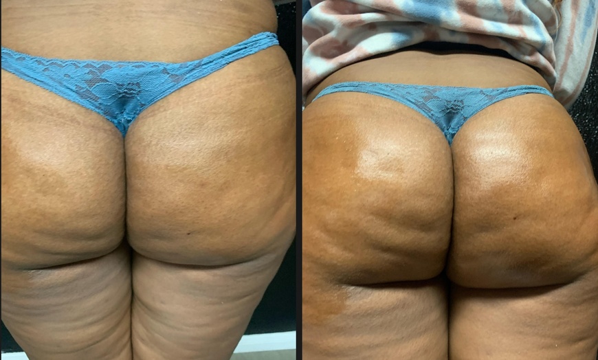 Image 1: Up to 42% Off on Lipo - Non-Invasive Laser-iLipo at Me, Myself, & I Industries LLC