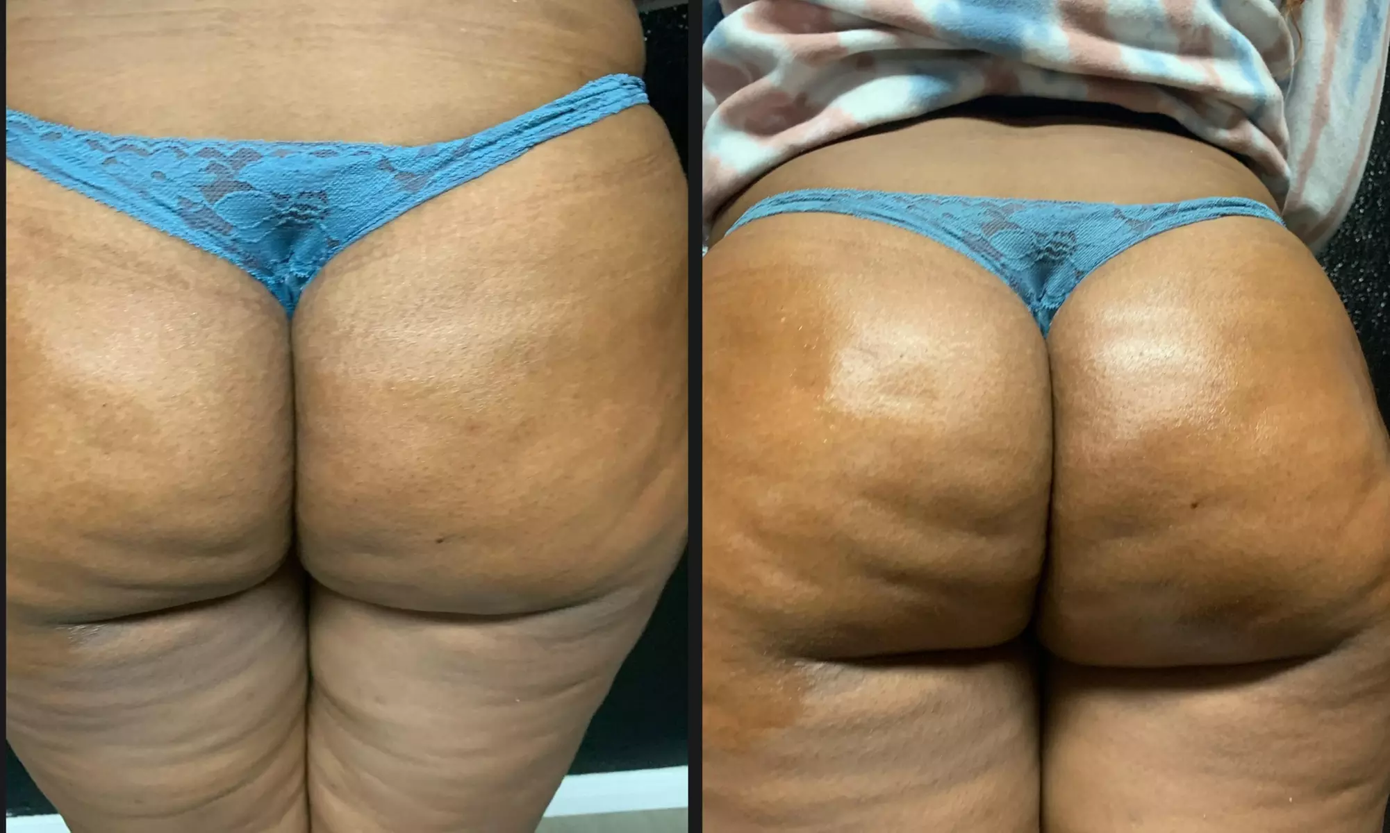 Up to 42% Off on Lipo - Non-Invasive Laser-iLipo at Me, Myself, & I Industries LLC - Primary Image