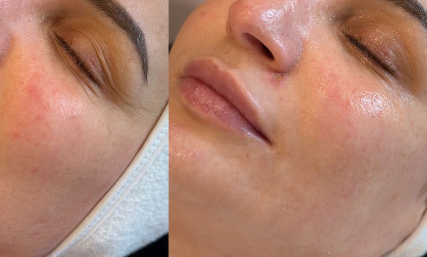 Image 2: 50% Rabatt auf Gesichtsbehandlung bei Lineva Aesthetics