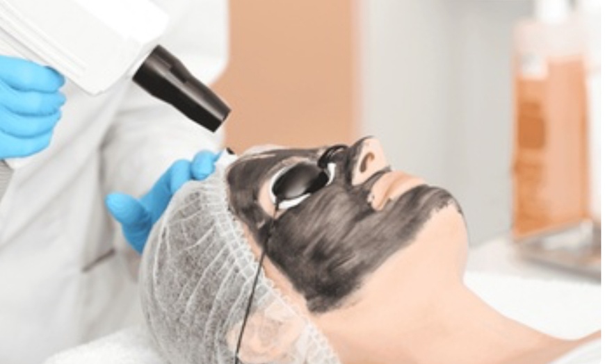 Image 1: Achieve Flawless Beauty with Carbon Peel Laser Facial