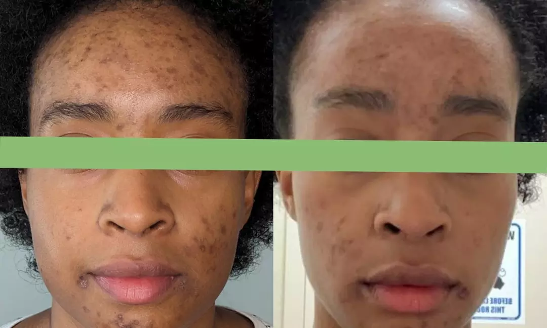 Enhance Your Skin with VI Medical Grade Chemical Peel at Saged NYC Aesthetics (Up to 48% Off) - Primary Image