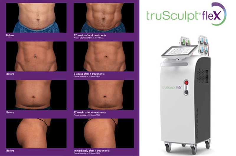Redefine Your Body With TruSculpt Flex and Massage Sessions