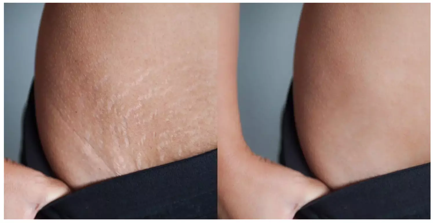 Experience Yaiza's Mystical Beauty with tattoo artistry for stretch mark camouflage in one or two areas up to 45% - Primary Image