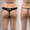 Image 4: Up to 46% Off on Lipo - Non-Invasive Laser-iLipo at Shapes Lymphatic