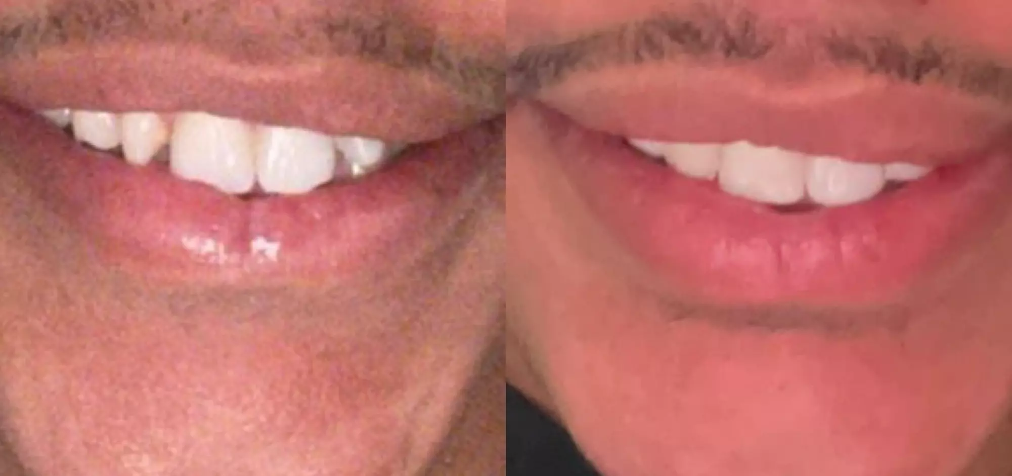 Up to 50% Off on Dental Implant / Corona / Veneer at New Smile by G - Primary Image