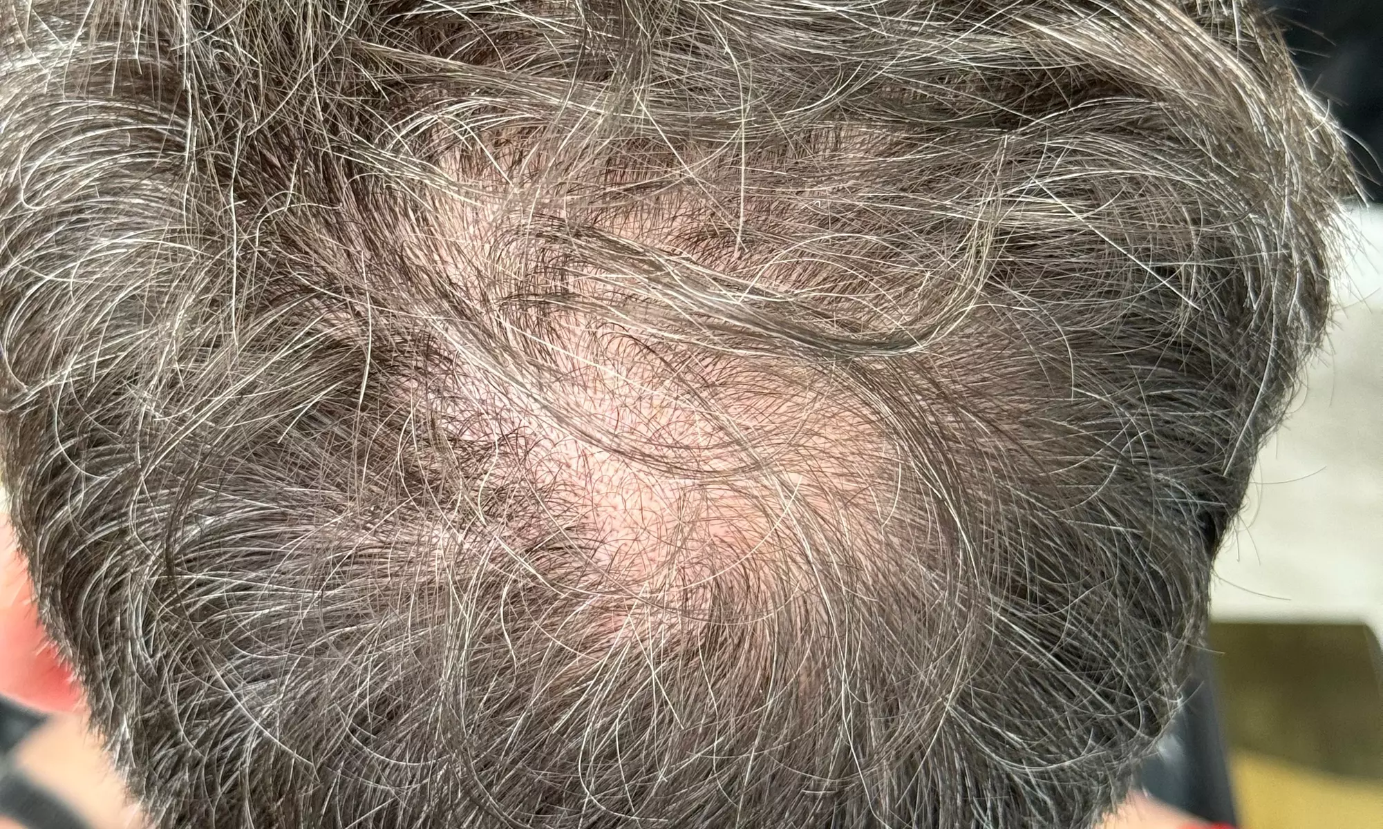 Up to 75% Off on Micro-Needling at Solulu Beauty Studio - Primary Image