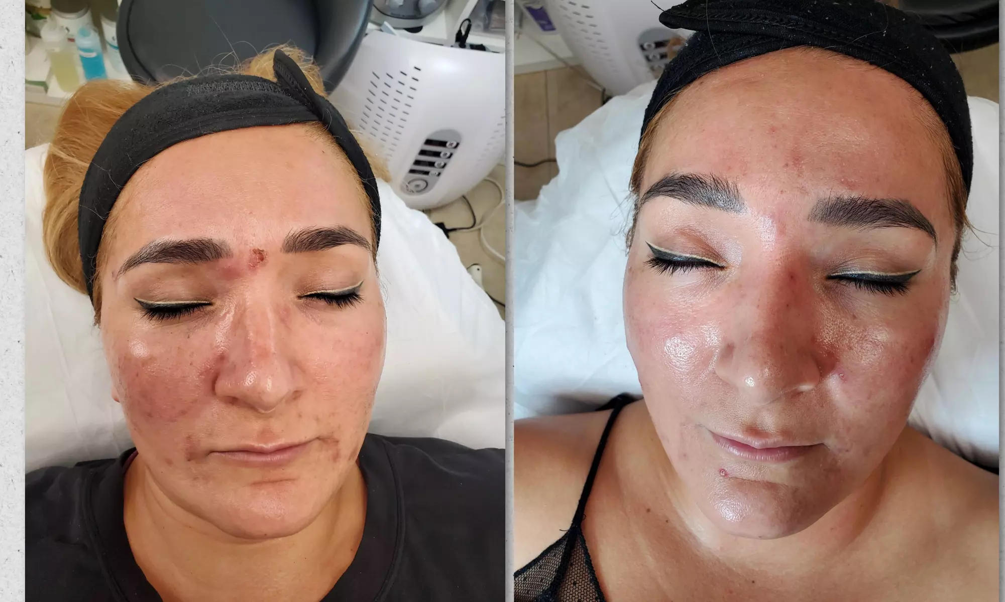 Clear Skin Journey: Acne Treatment Sessions to Transform Your Skin