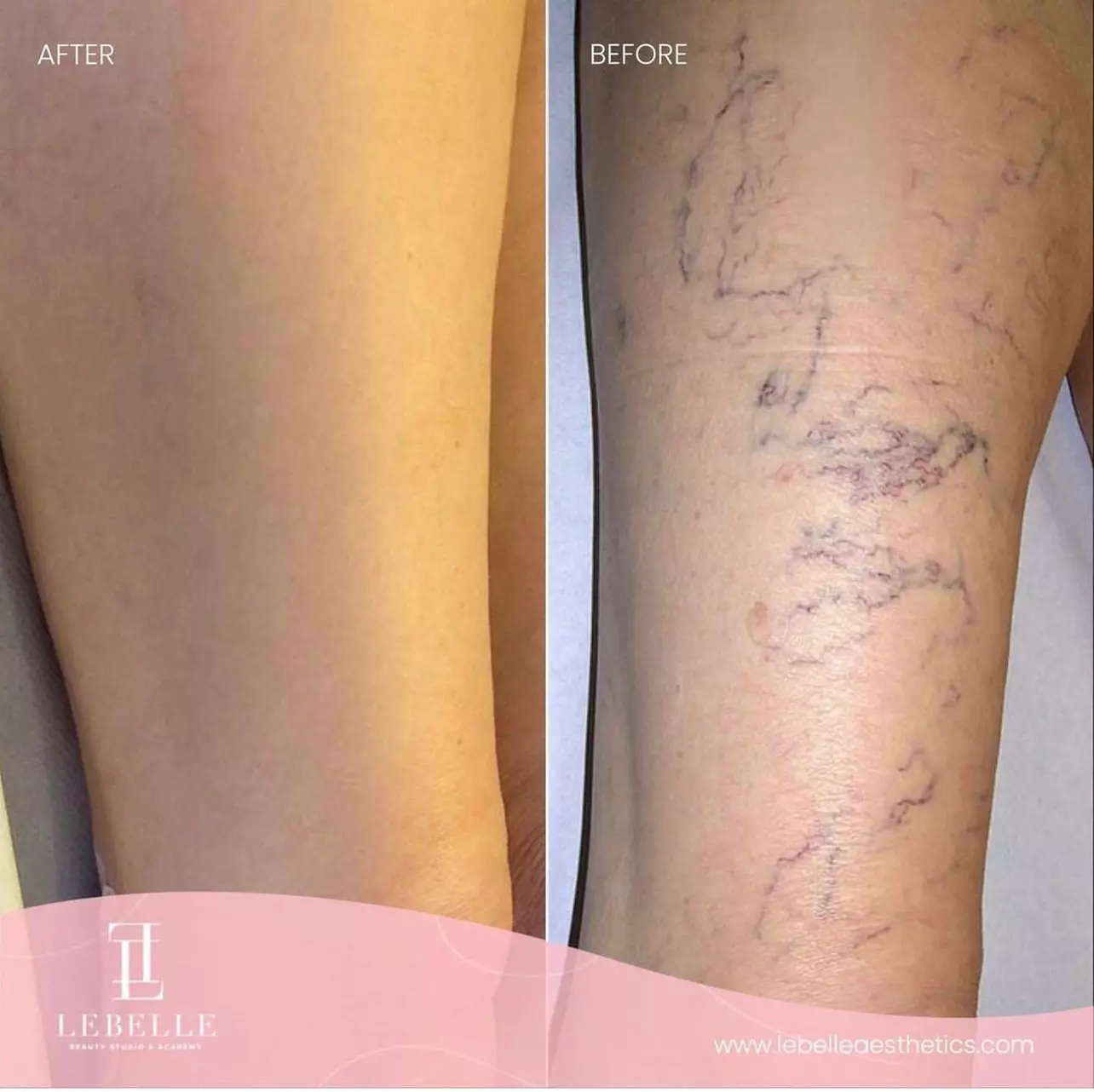 Up to 37% Off on Spider Vein Removal - IPL at Le Belle Aesthetic & Laser - Second Medium