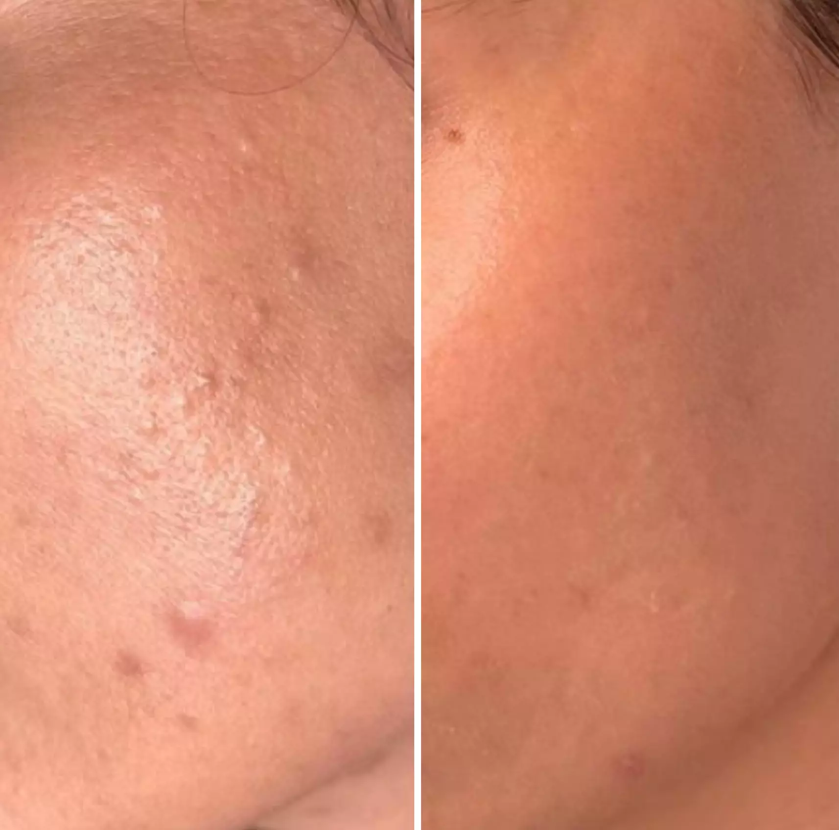 Up to 69% Off on HydraFacial at Skin & Laser Aesthetics