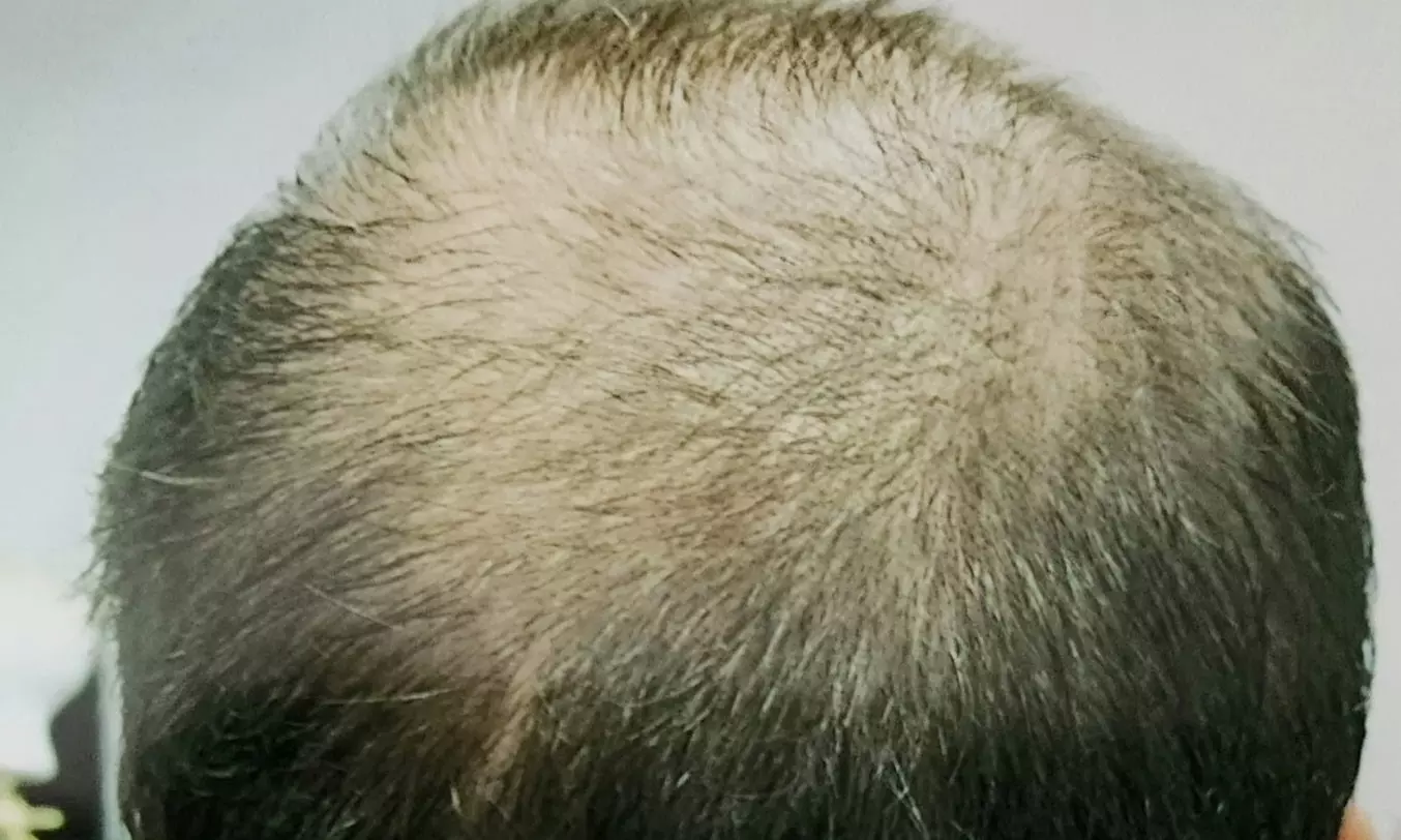 $157 Off $350 Worth of Hair Restoration - Other - Second Medium