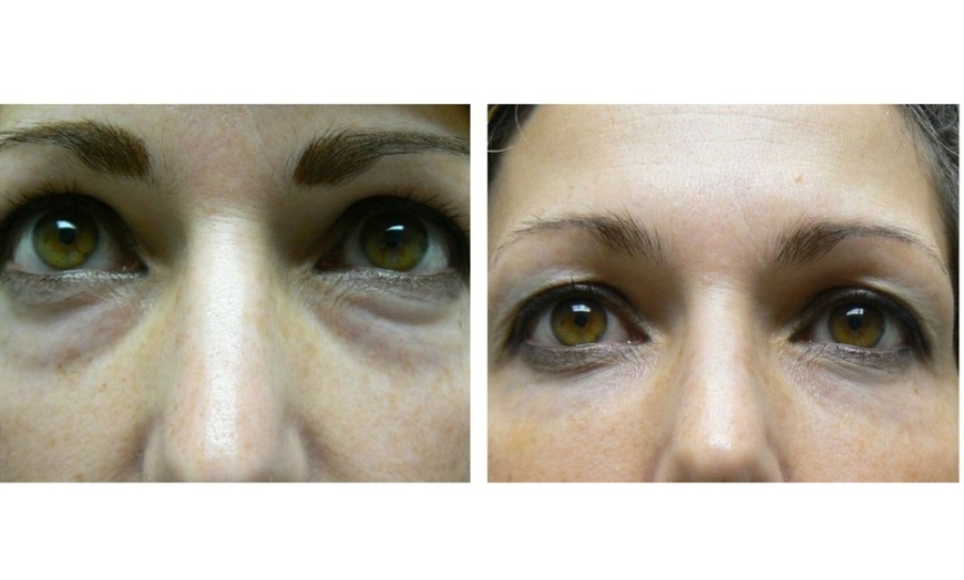 Image 4: One Belotero syringe for undereyes
