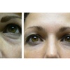 Image 4: One Belotero syringe for undereyes