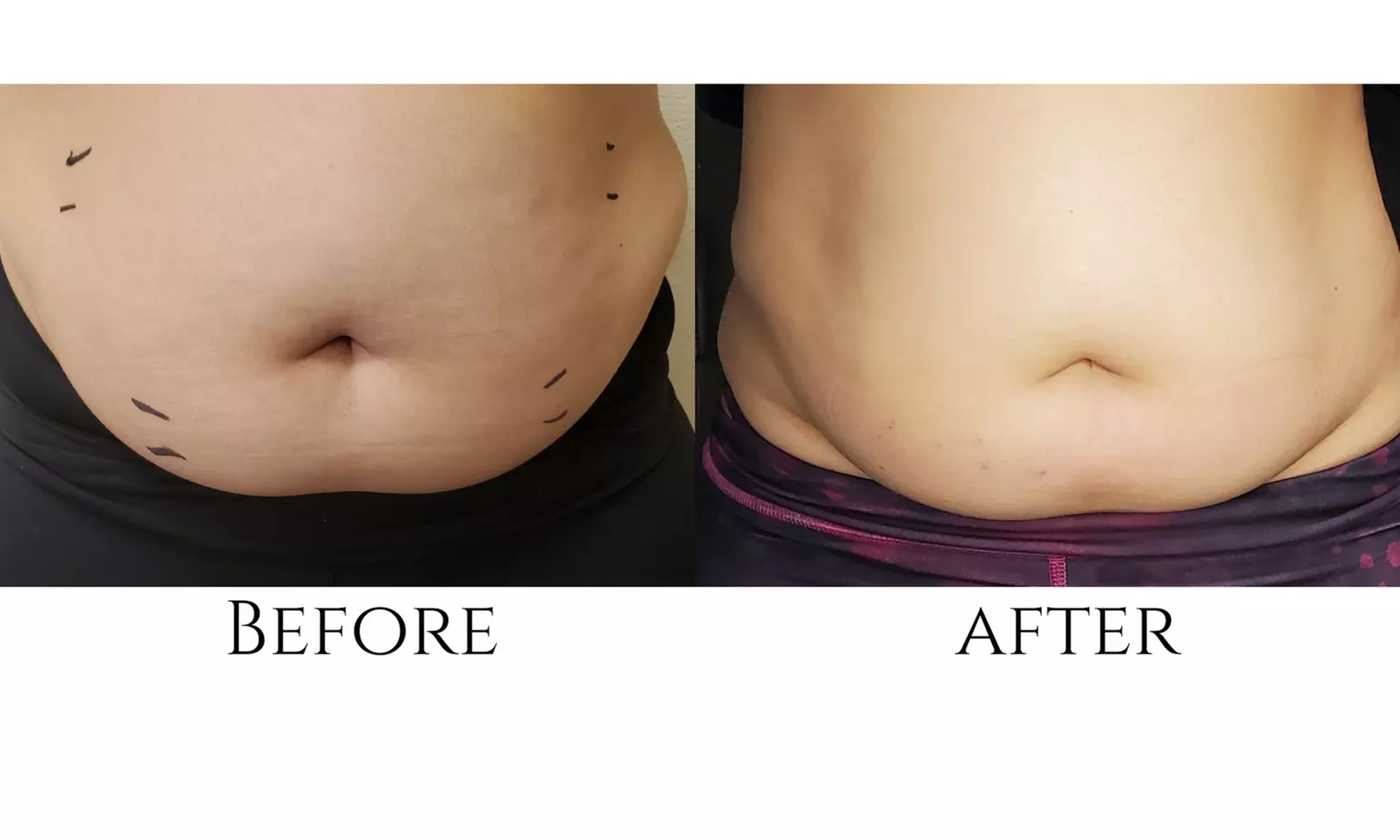 Up to 33% Off on Ultrasonic Fat Reduction at Aesthetic Preserve Contour And Wellness Center - Second Medium