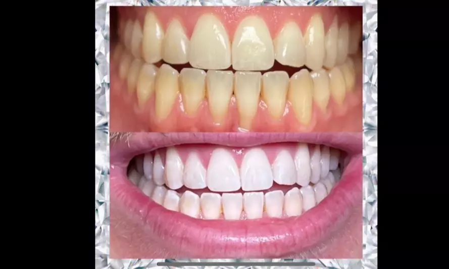 Up to 51% Off on Teeth Whitening - In-Office - Non-Branded at PLATINUM +Teeth Whitening - Primary Image