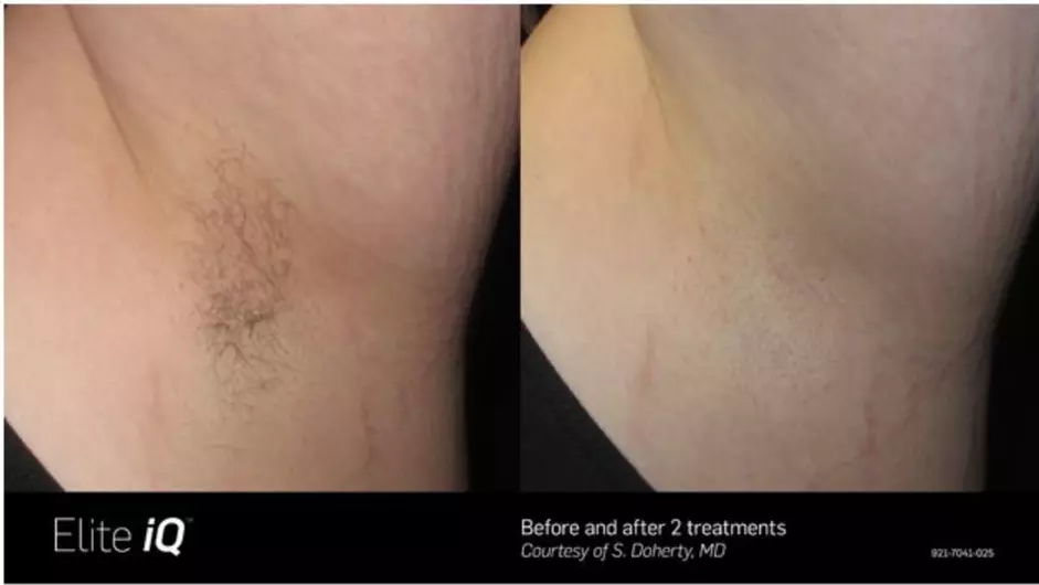 Up to 35% Off on Laser Hair Removal at Skinpro Vancouver - Second Medium